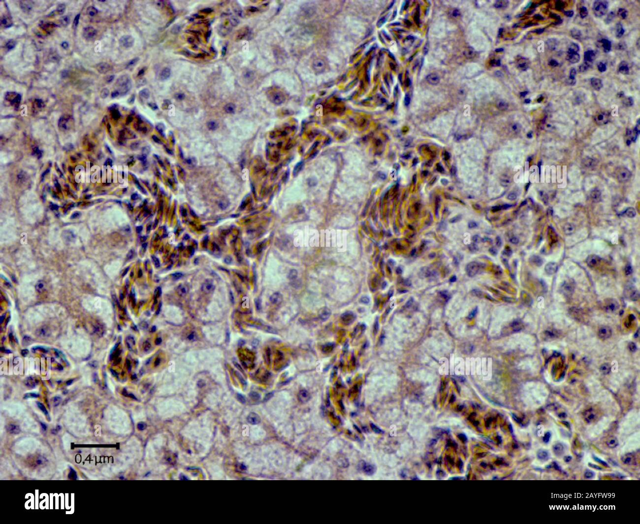 histological cut of tissue of secondary hepatic cancer, 2000 x Stock Photo