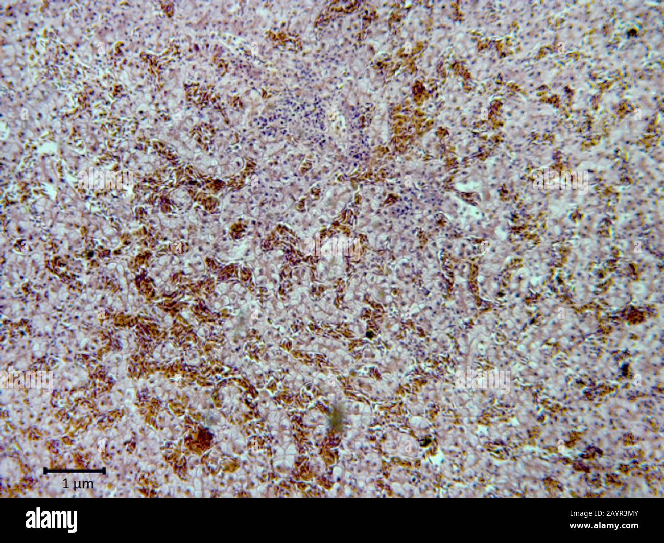 histological cut of tissue of secondary hepatic cancer, 500 x Stock Photo