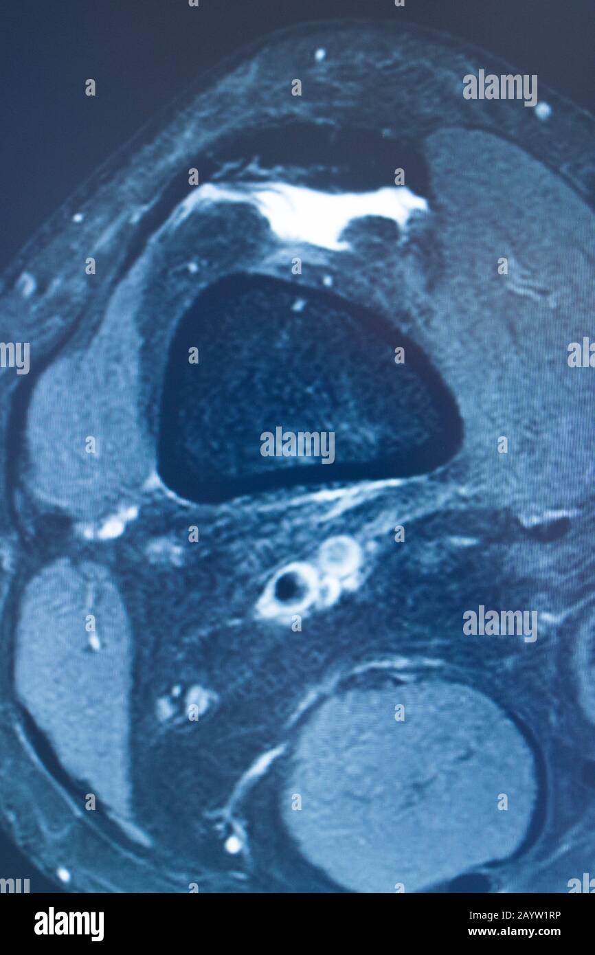 Knee sports injury mri mcl grade 2 tear resonance imaging