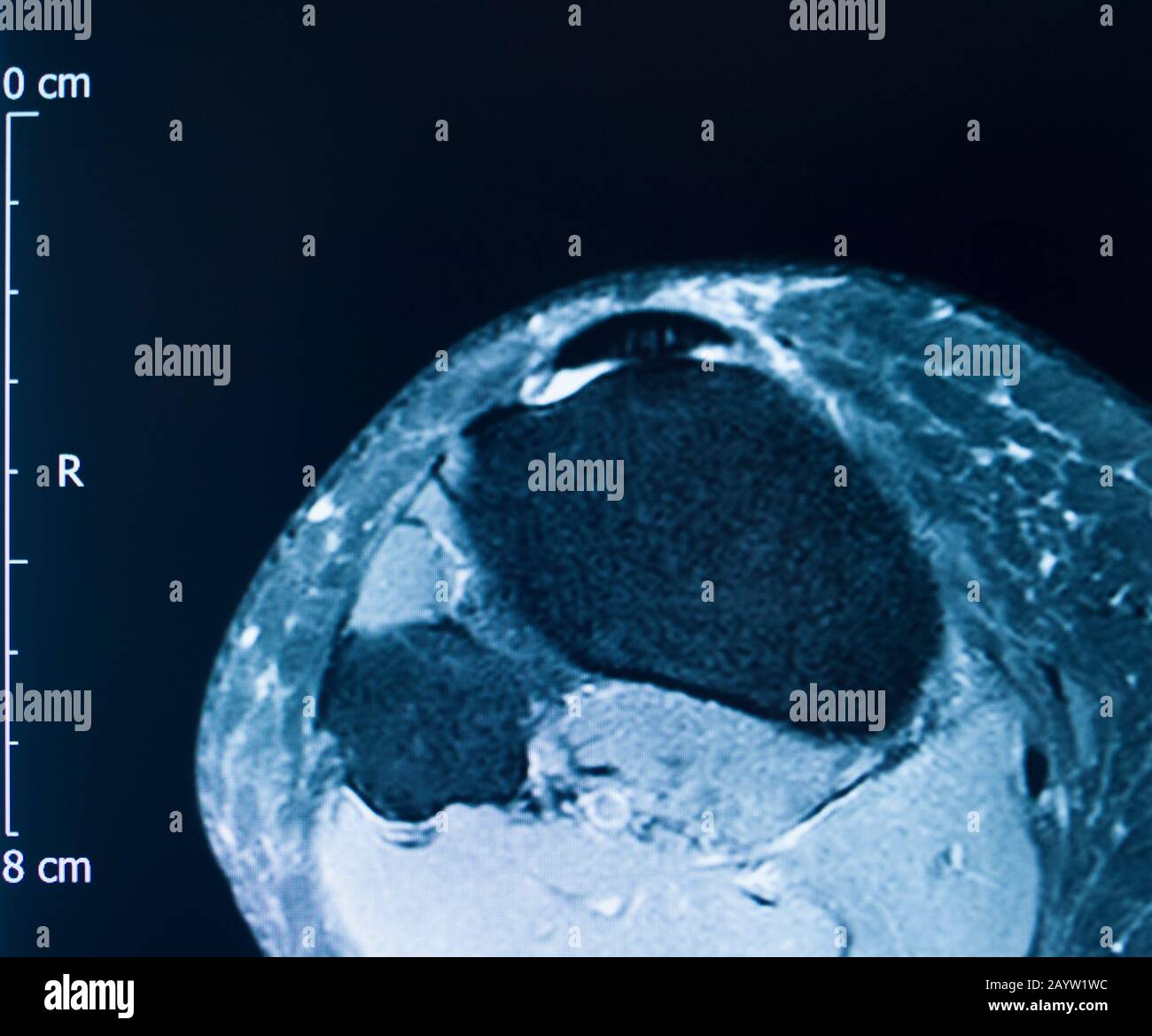 Knee sports injury mri mcl grade 2 tear resonance imaging