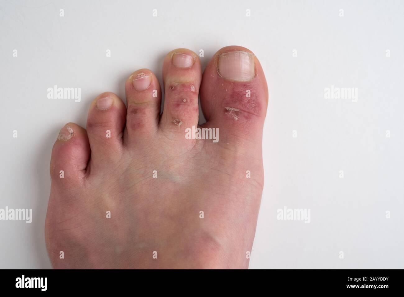 Amman/ Jordan - February 05 2020, Dermatitis also known and Eczema, causing rash, dryness, itchiness on feet of a 40 year old female Stock Photo