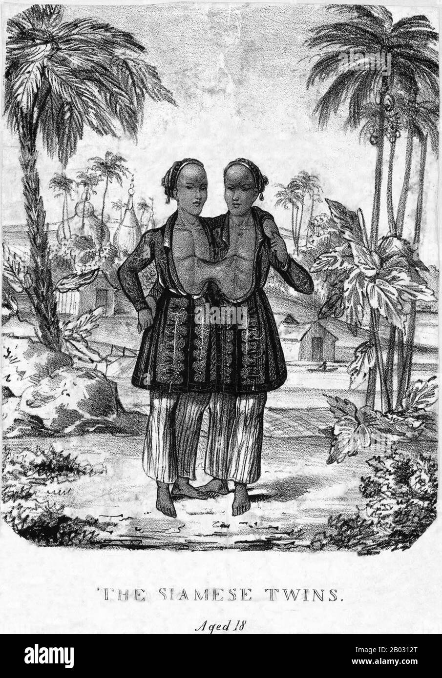 Chang and Eng Bunker (May 11, 1811 – January 17, 1874) were Thai-American conjoined twin brothers whose condition and birthplace became the basis for the term 'Siamese twins'.  The Bunker brothers were born on May 11, 1811, in the province of Samut Songkram, near Bangkok, in the Kingdom of Siam (today's Thailand). Their fisherman father was a Chinese Thai, while their mother was a Chinese Malaysian. Because of their Chinese heritage, they were known locally as the 'Chinese Twins'. The brothers were joined at the sternum by a small piece of cartilage, and though their livers were fused, they we Stock Photo