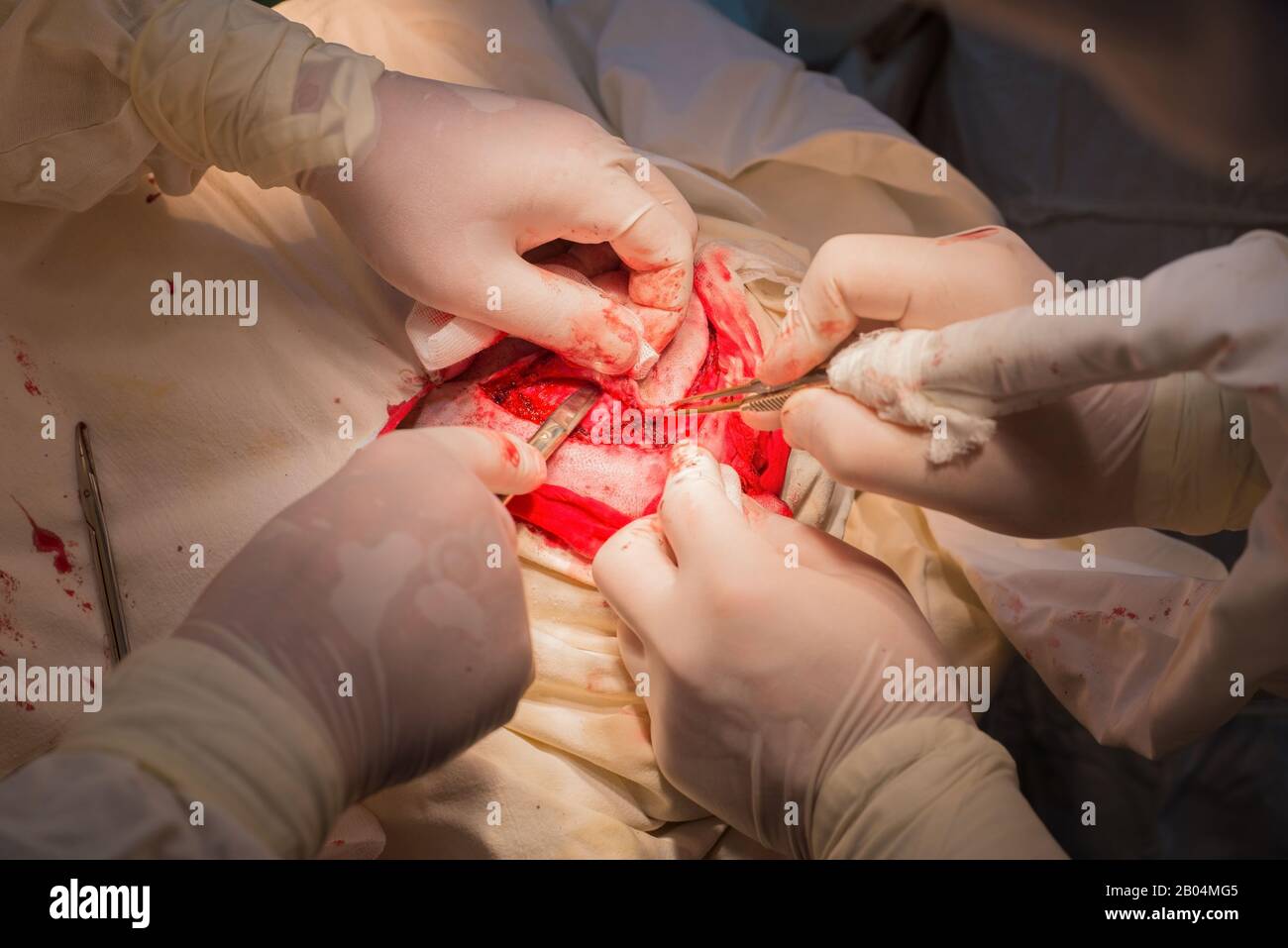 top view, stages of neurosurgical surgery for installing a titanium plate in the patients skull. Pediatric neurosurgery. Craniotomy. Incision of the s Stock Photo