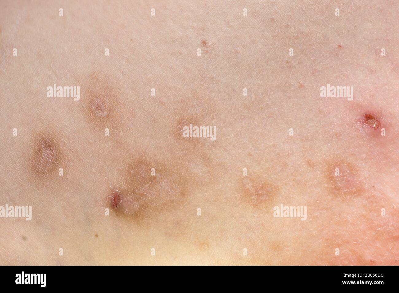 Prurigo. Skin manifestations of a chronic disease with reddish-brown papules, depigmentation sites and crusts after scratching Stock Photo