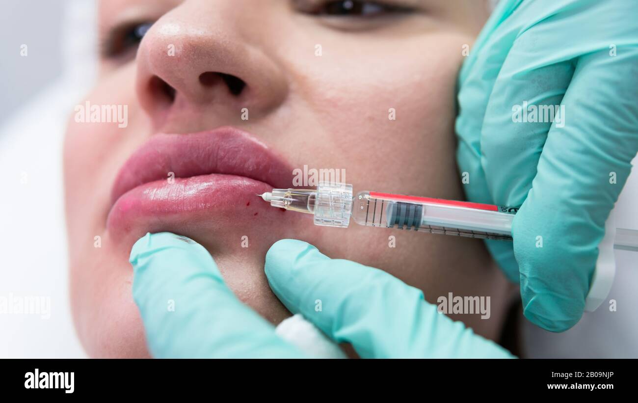 The young beautician doctor preparing to making injection in female lips. The doctor cosmetologist makes lip augmentation procedure. Concept of beauty Stock Photo