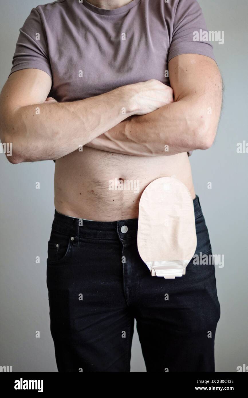 90+ Ileostomy Bag Stock Photos, Pictures & Royalty-Free Images - iStock