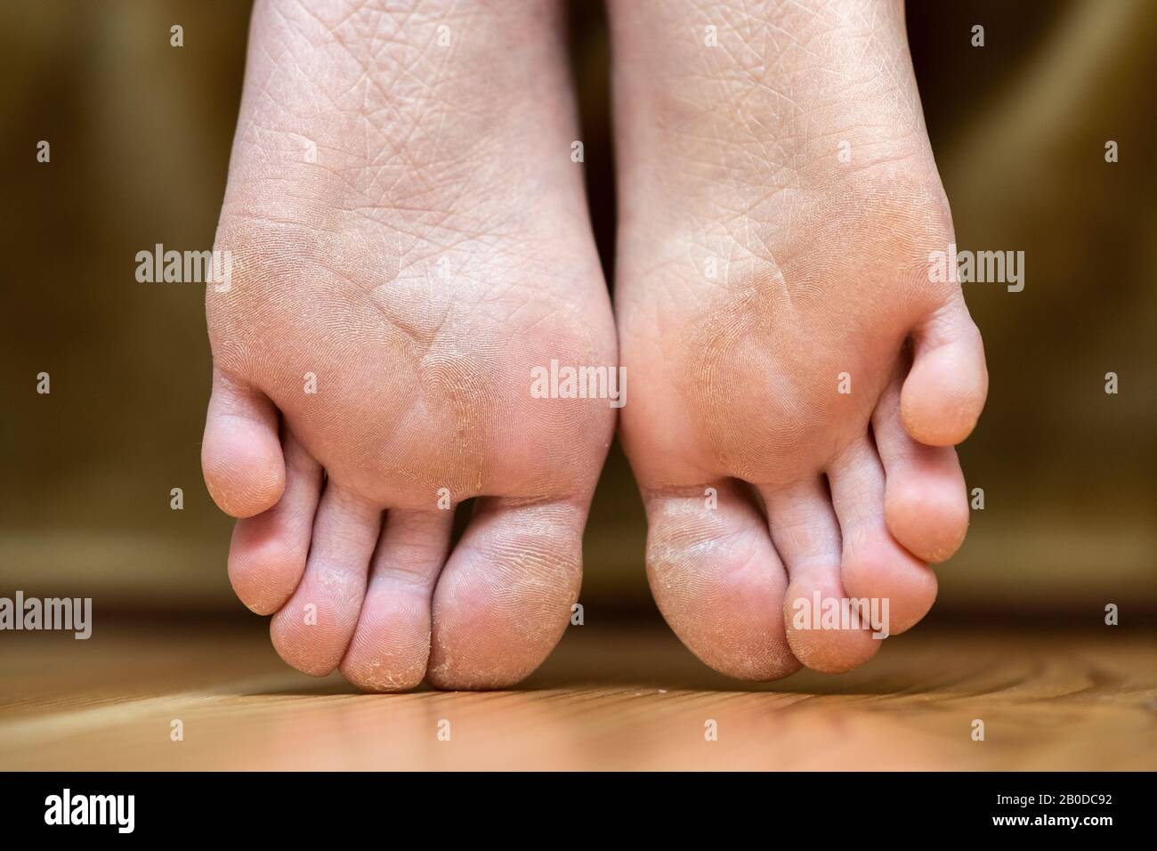dry cracked skin on bottom of feet