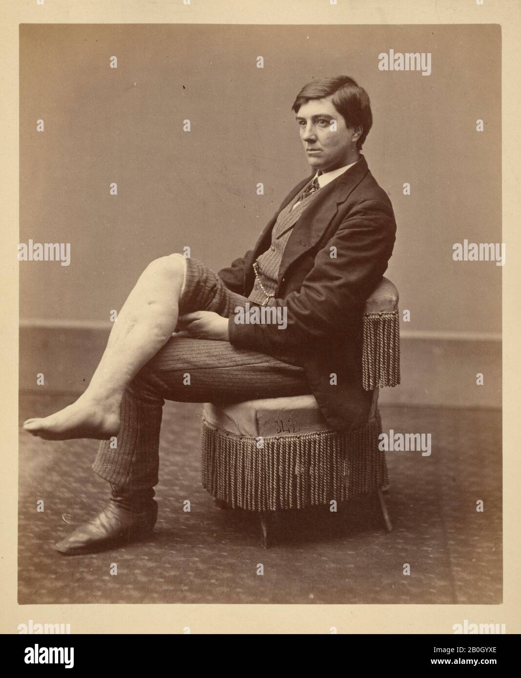 Army Medical Museum photographer, American, late 19th century, Necrosis of Right Tibia Following Gunshot Fracture, 1873, Albumen print from wet-collodion-on-glass negative, Overall: 7 1/8 x 5 7/8 in. (18.1 x 14.9 cm Stock Photo