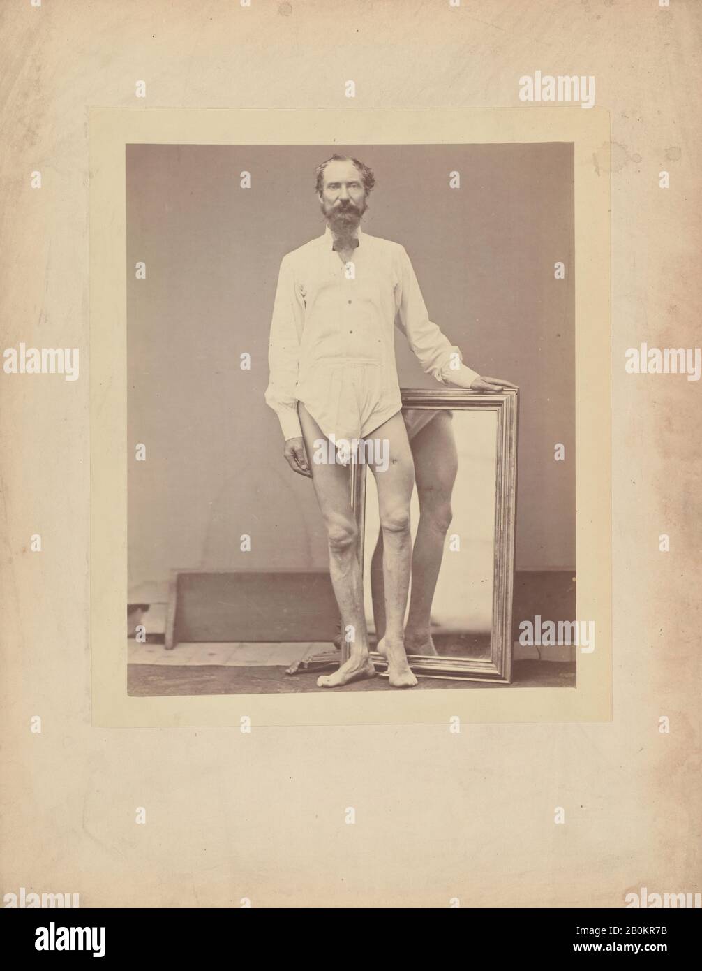 William Bell, Gunshot Wound of Middle Third of Left Femur, William Bell (American (born England) Liverpool 1831–1910 Philadelphia, Pennsylvania), 1865–67, Albumen silver print from glass negative, Image: 8 in. × 6 9/16 in. (20.3 × 16.6 cm), Mount: 13 7/8 × 10 7/8 in. (35.2 × 27.7 cm), Photographs Stock Photo