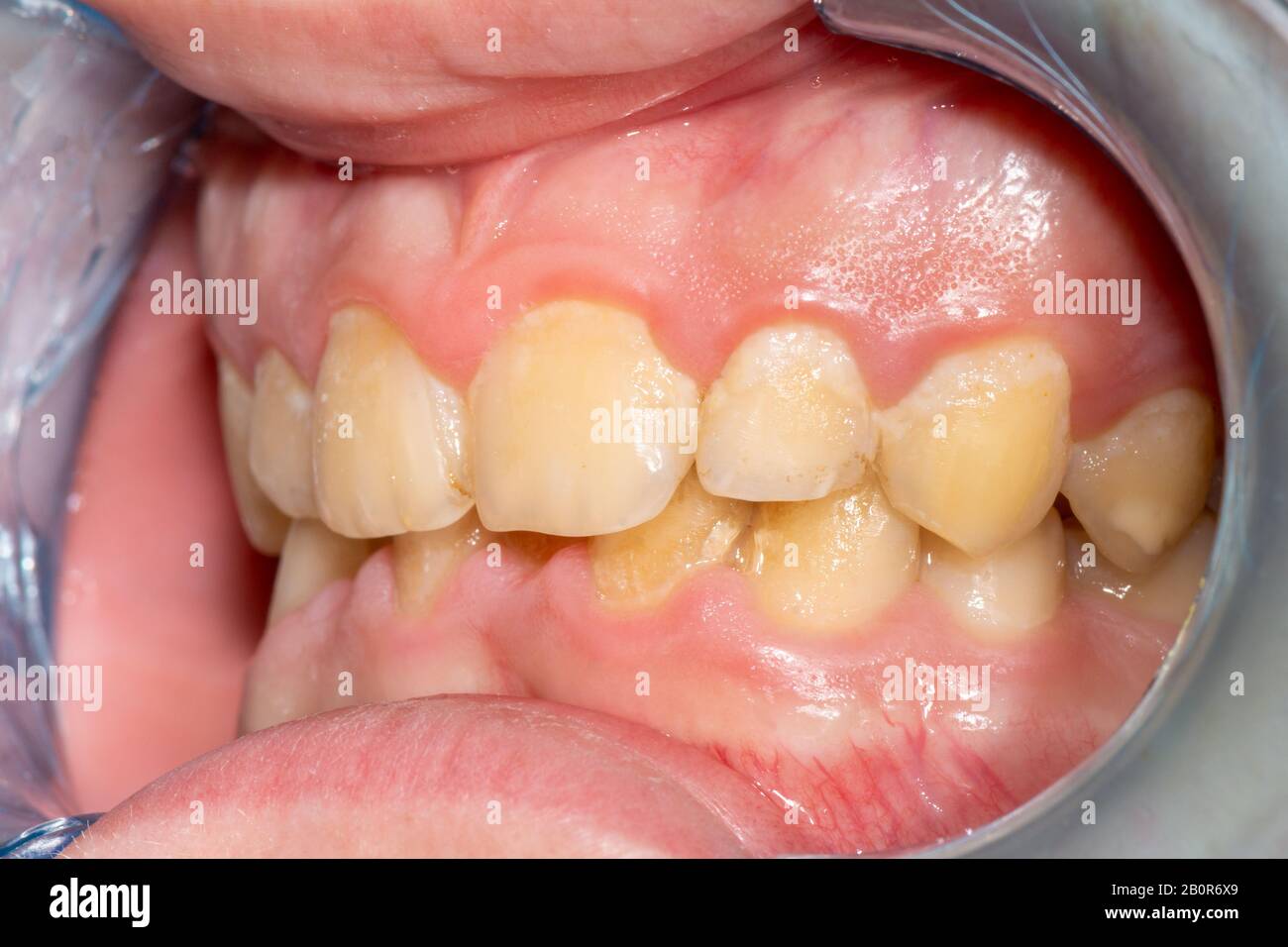 Dental caries. Filling with dental composite photopolymer material using rabbders. The concept of dental treatment in a dental clinic Stock Photo