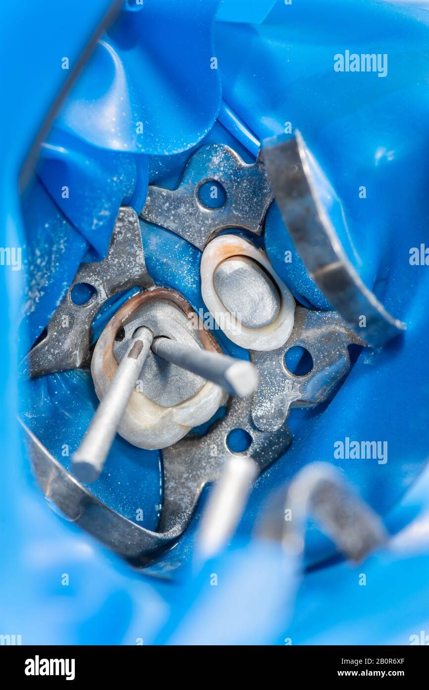 manufacture and installation of dental pins and impressions in dentistry. The process of treating decayed teeth by dentist Stock Photo