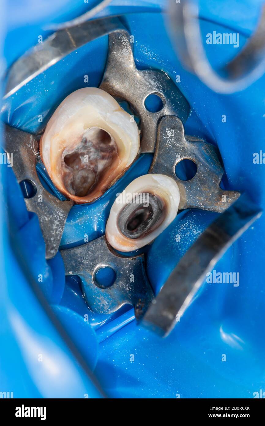 manufacture and installation of dental pins and impressions in