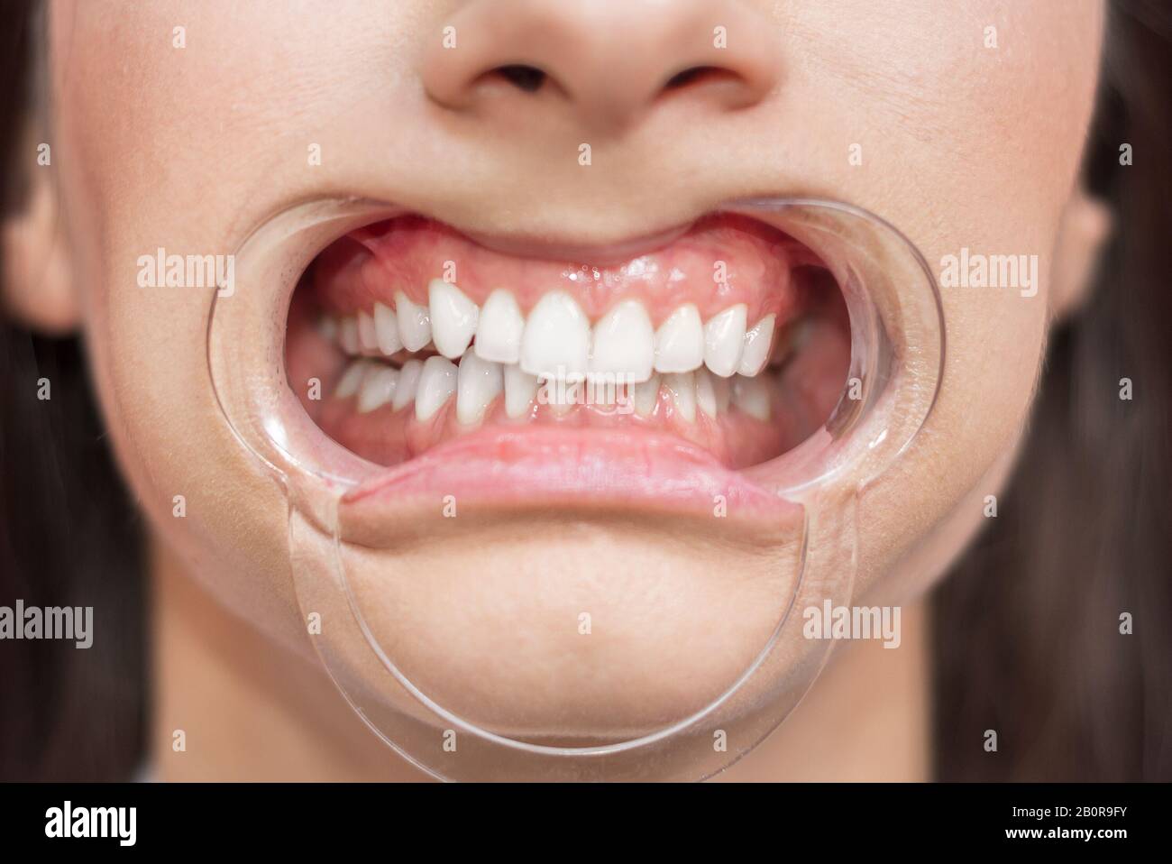 Tooth whitening tray hires stock photography and images Alamy