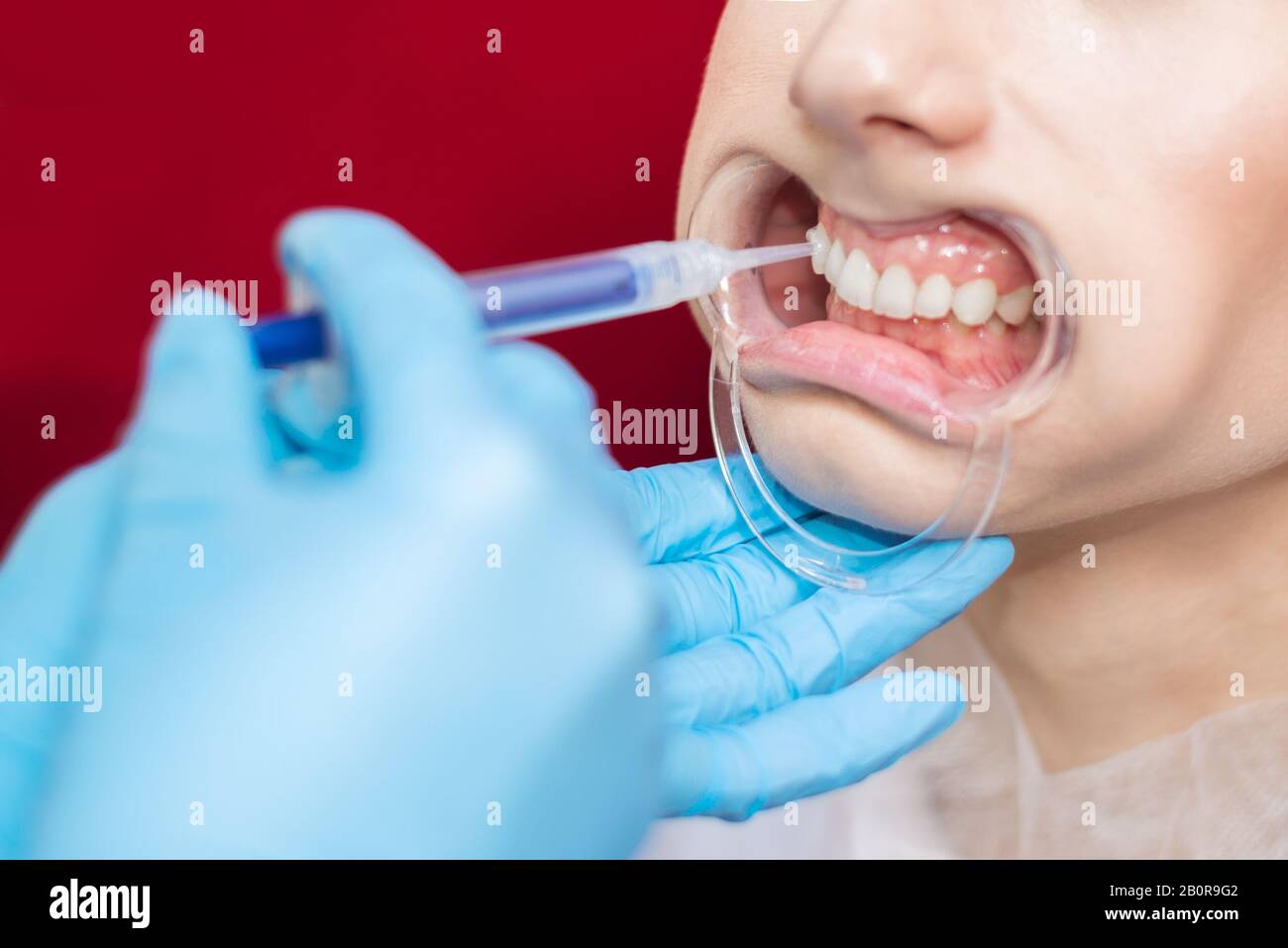 Dentist applies a tooth whitening gel with a syringe. girl with open