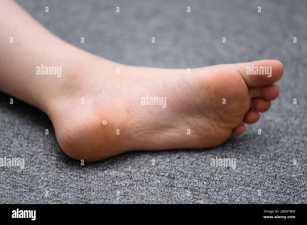 Foot wart, verrucas plantar on the foot of a child. A decease caused by the Human papillomavirus and often spread at communal showers. Stock Photo