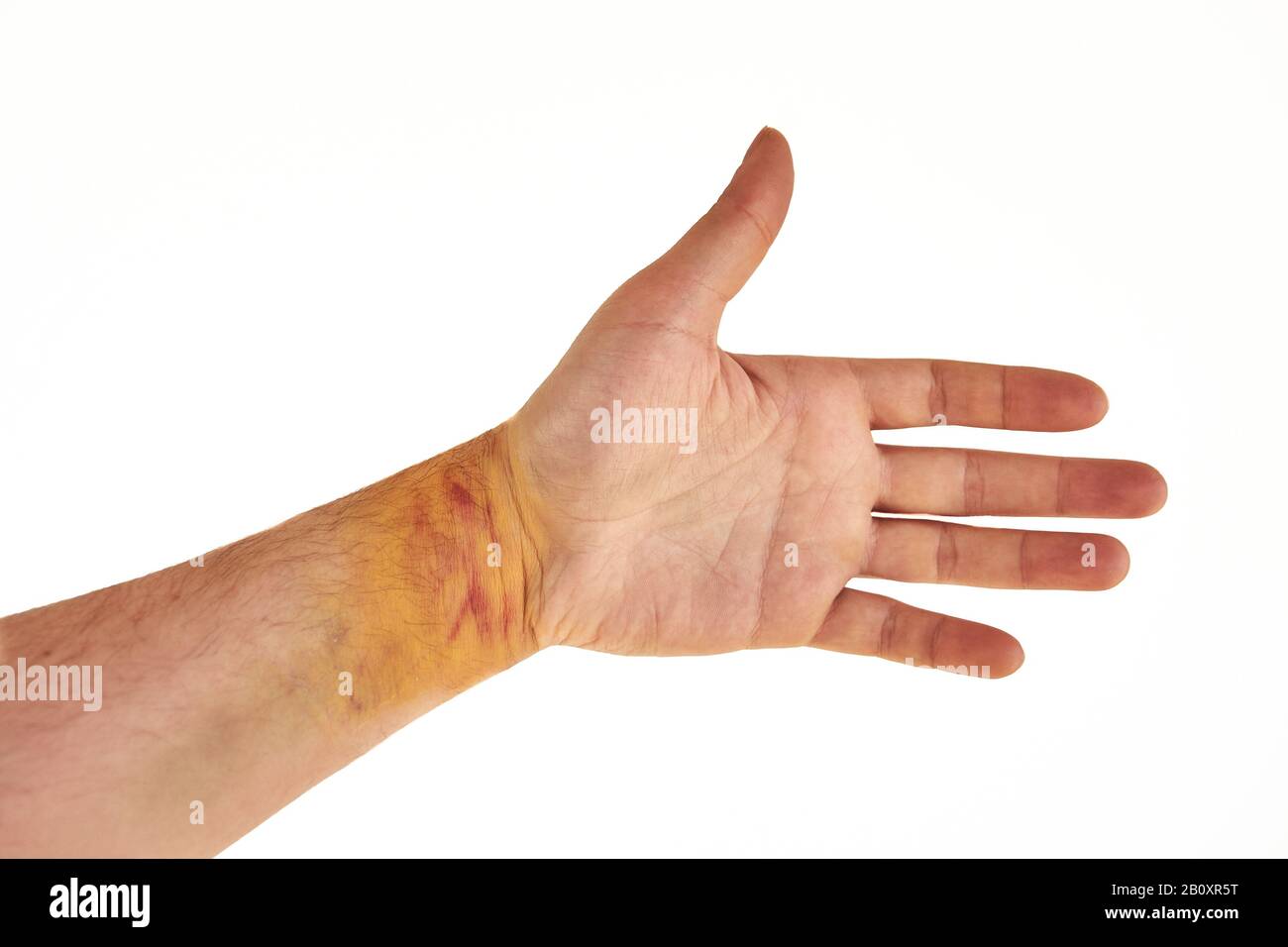 Hematoma arm hires stock photography and images Alamy