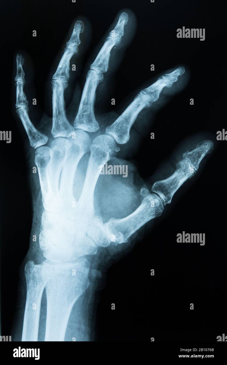 xray scan of hand Stock Photo