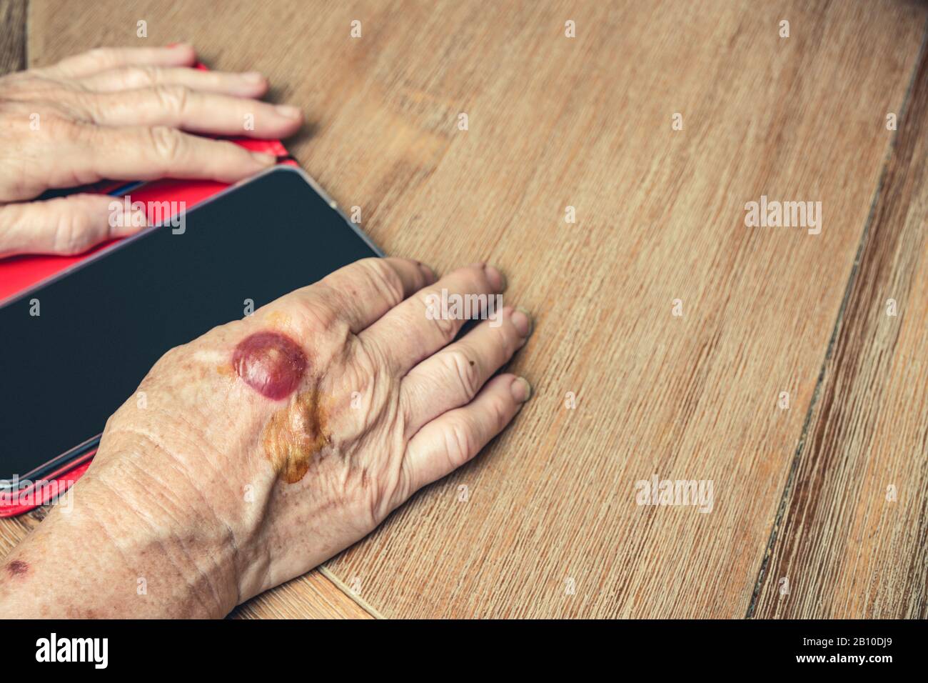 Elderly woman's hands with large blister from skin cancer treatment searching for medical advice online - healthcare and medical / technology concept i Stock Photo