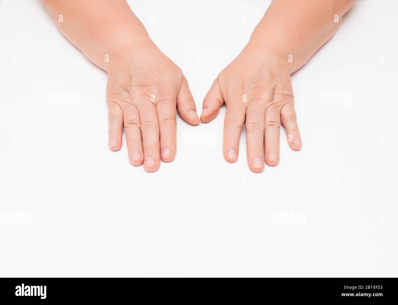 Dry skin with wrinkles on the hands of an elderly woman, white background, isolate. Fragility of blood vessels, vitamin deficiency Stock Photo