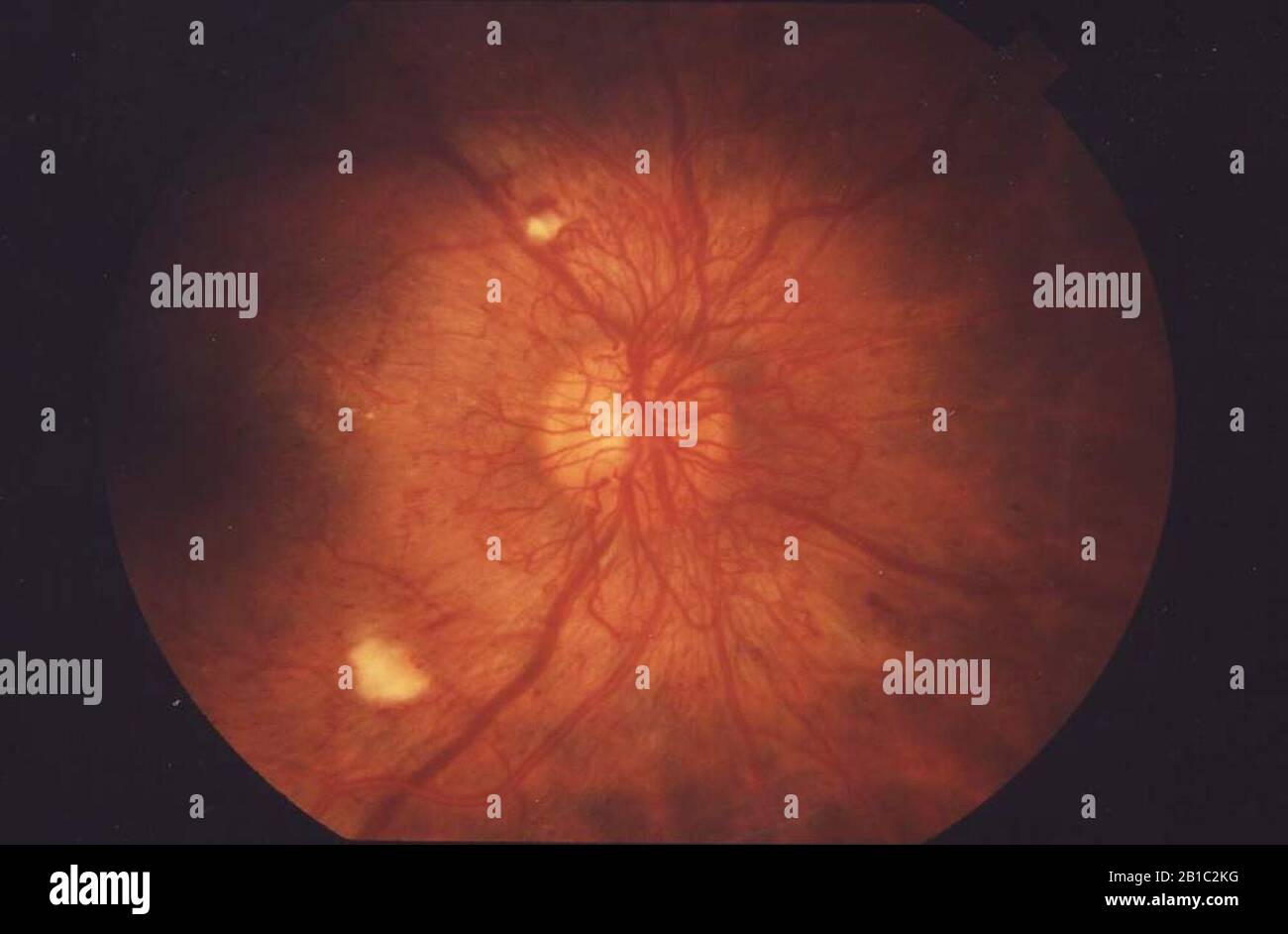 Fundus Proliferative retinopathy EDA01. Stock Photo