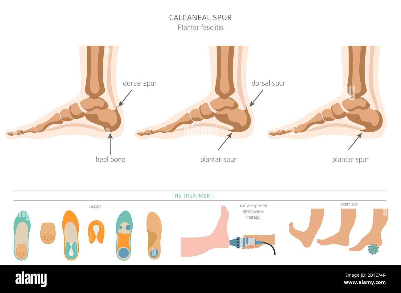 Calcaneal spur. Plantar fasciitis set. Medical desease infographics collection. Vector illustration Stock Vector