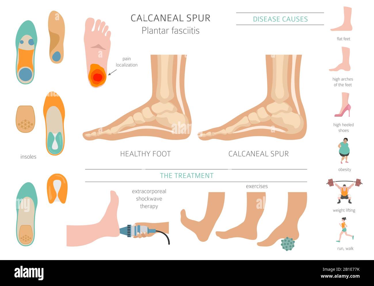 Calcaneal spur. Plantar fasciitis set. Medical desease infographics collection. Vector illustration Stock Vector
