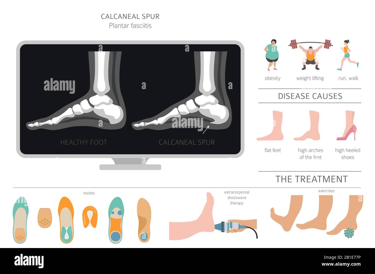 Calcaneal spur. Plantar fasciitis set. Medical desease infographics collection. Vector illustration Stock Vector