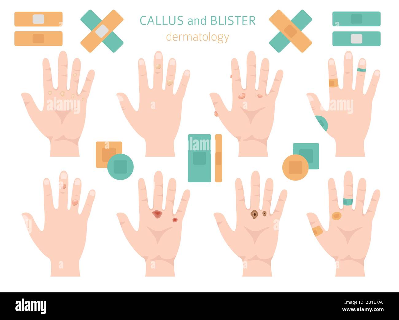 Callus, corn and blister feet and hands. Dermatology. Medical desease infographics collection. Vector illustration Stock Vector