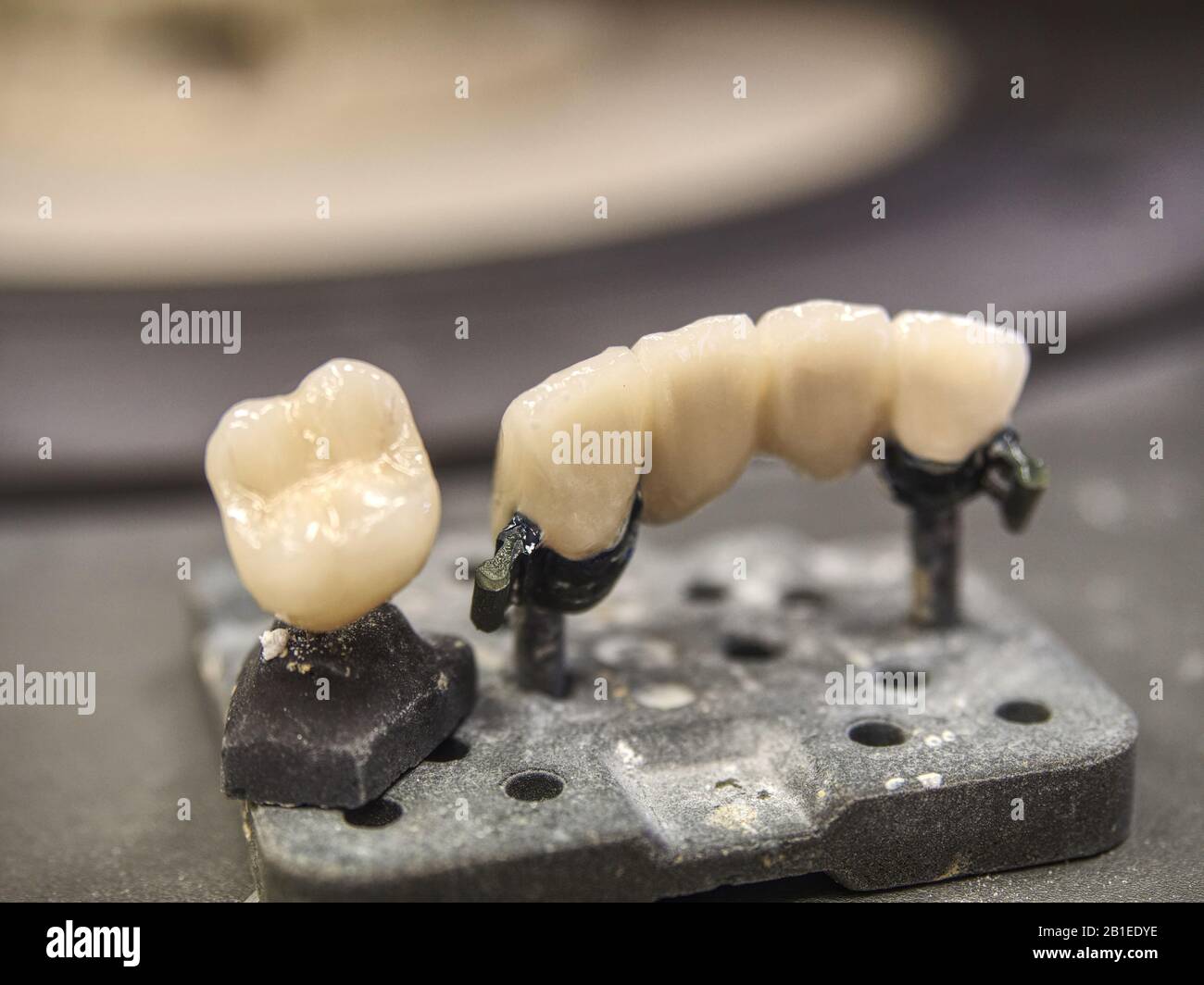 Ceramicmetal crowns and partial ceramicmetal bridge. Replacement of artificial tooth