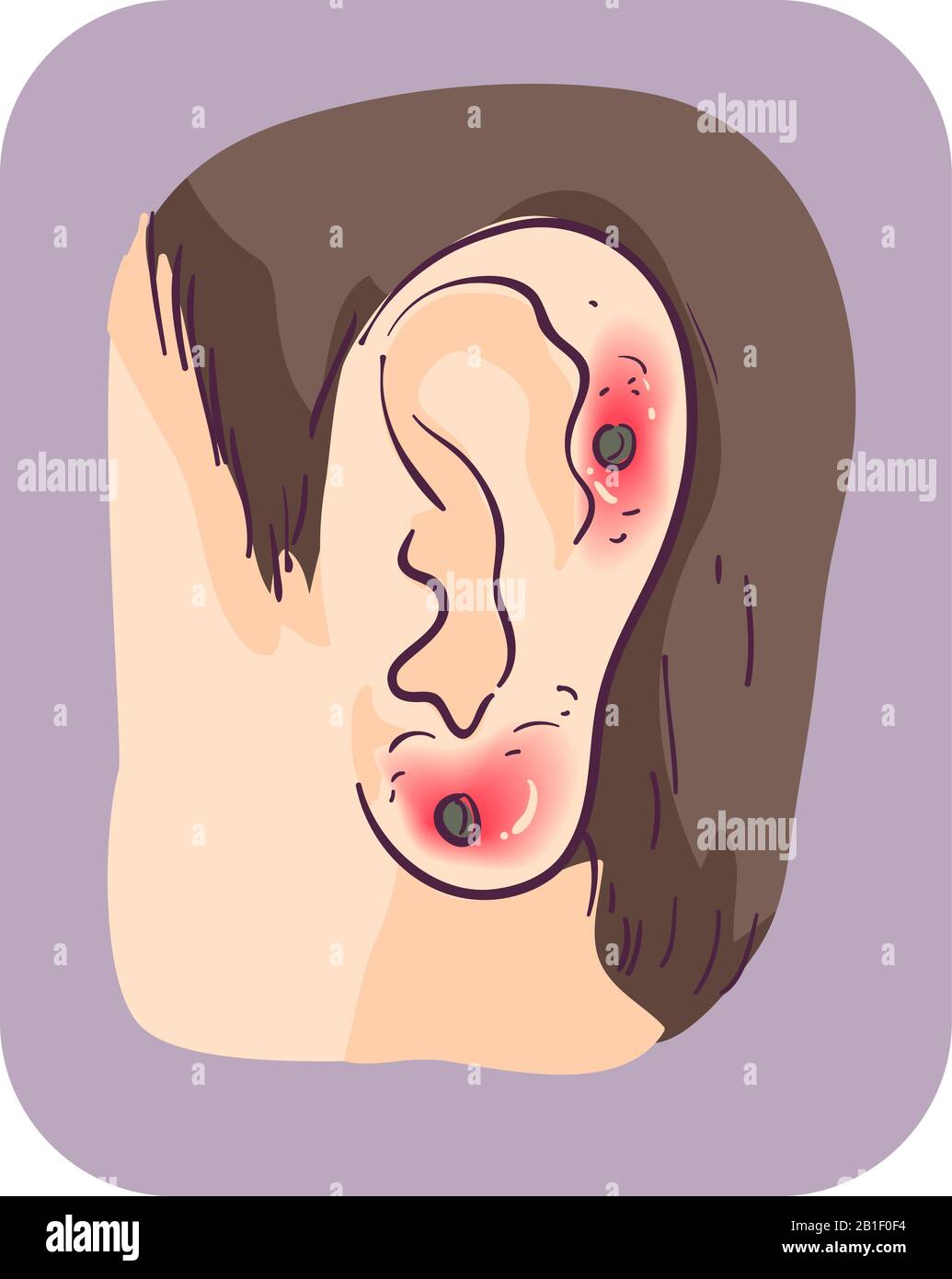 Illustration of an Ear of a Man with Irritated Ear Piercing Stock Photo
