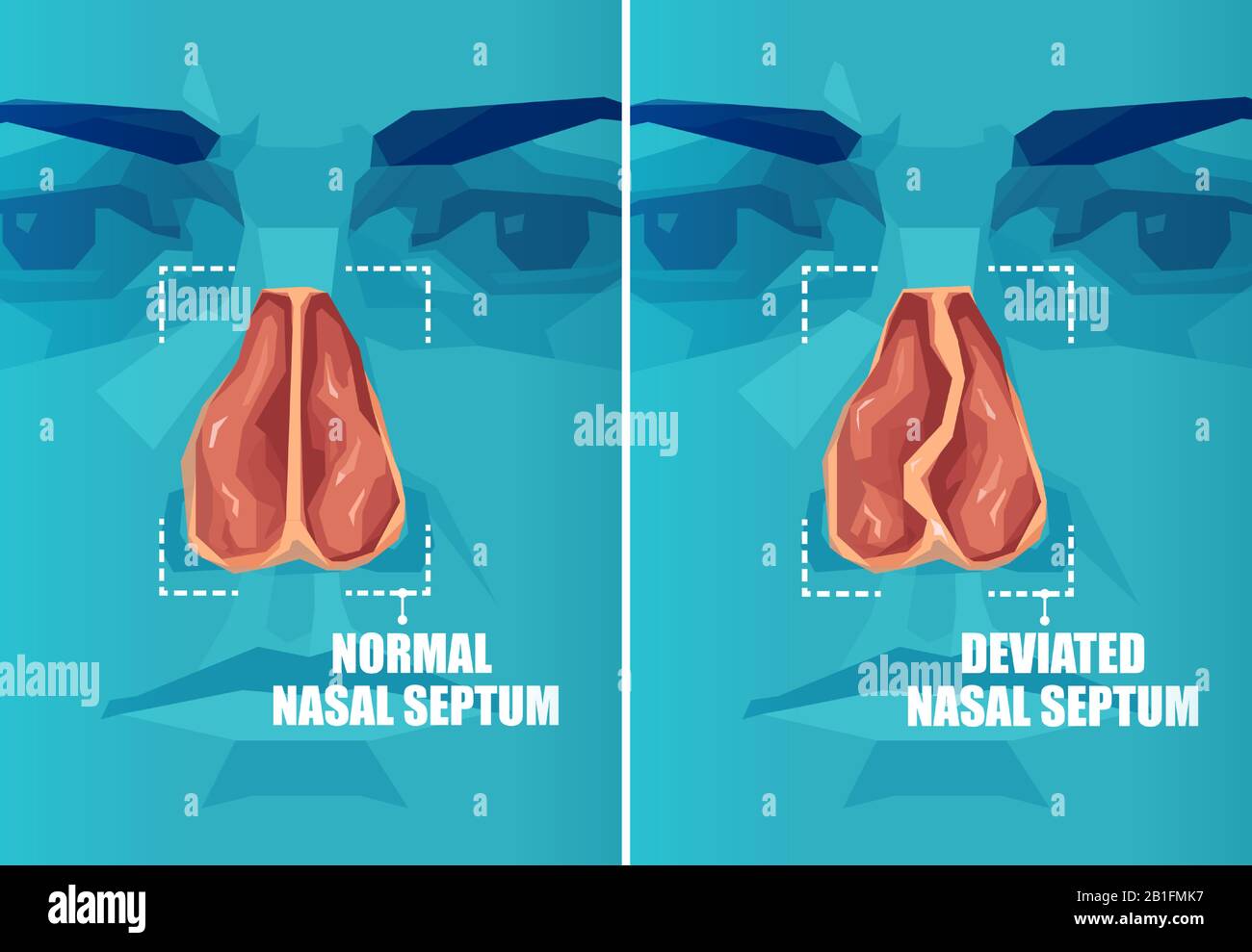 Vector cross section of human face with deviated and normal nasal septum Stock Vector