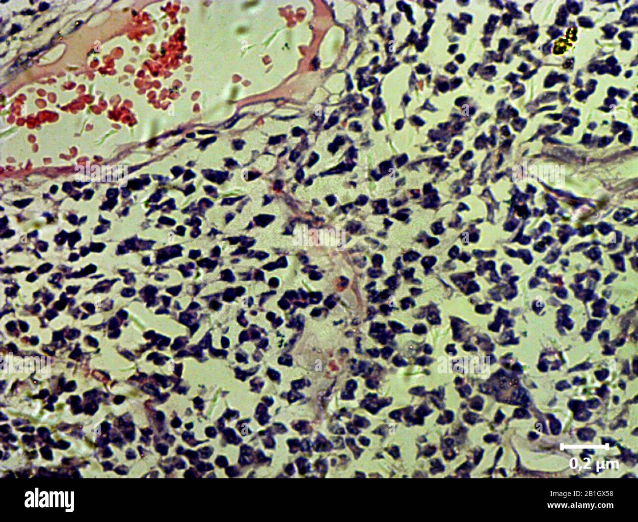 histological cut of tissue of cervical cancer, 2000x Stock Photo