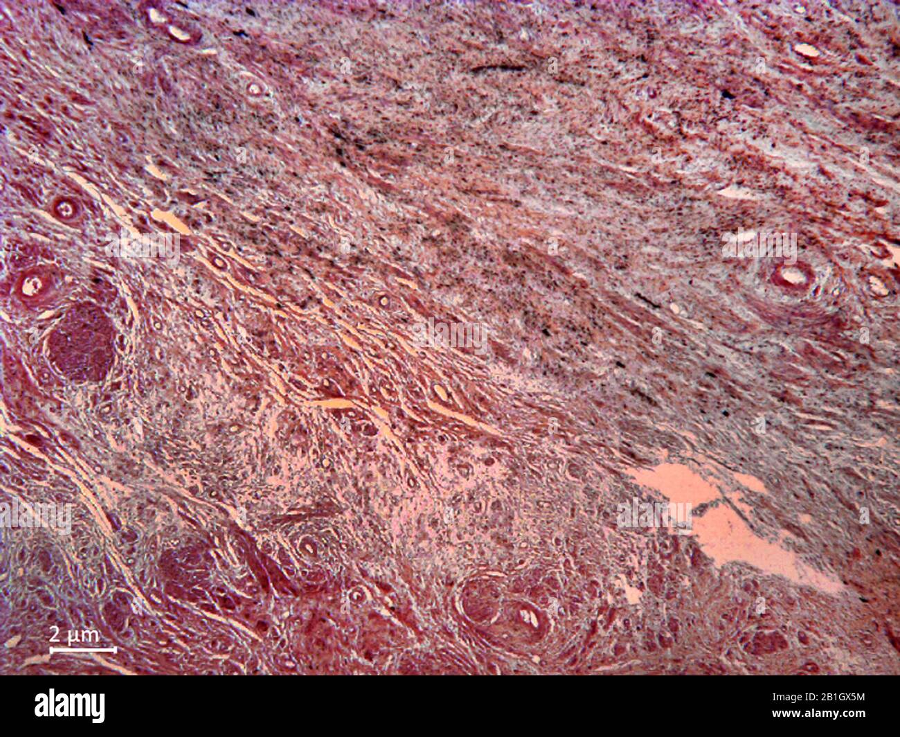 histological cut of tissue of a uterus with Fibroadenoma, 200x Stock Photo