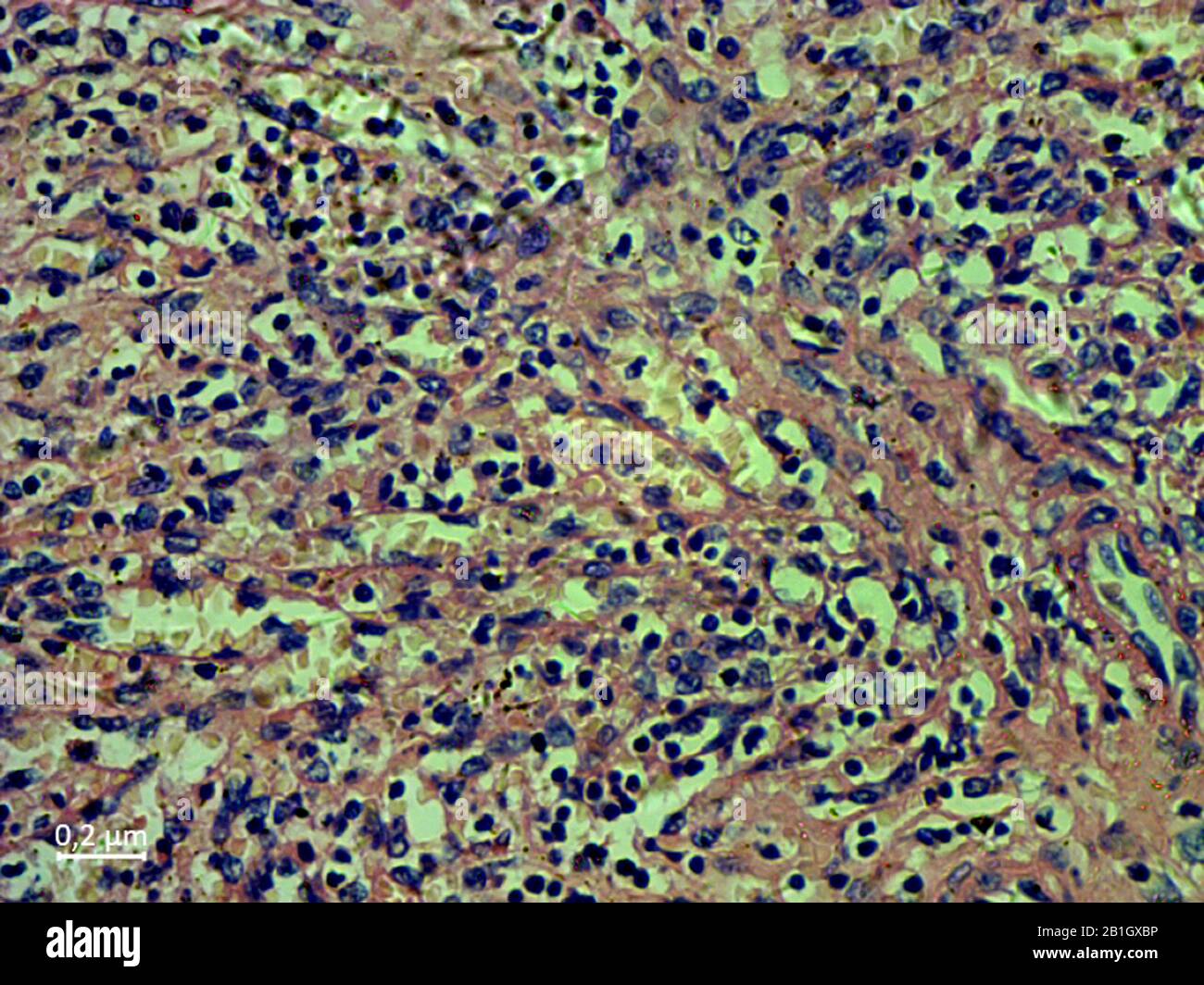 histological cut of tissue of spleen, chronic myeloic leuceamia  blood smear, 2000x Stock Photo