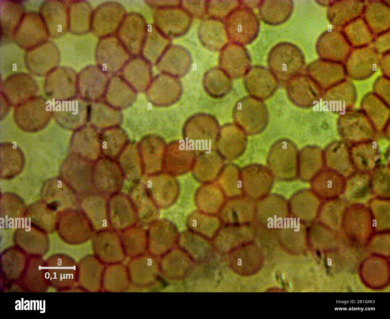 leukemia, blood smear, 5000x Stock Photo - Alamy