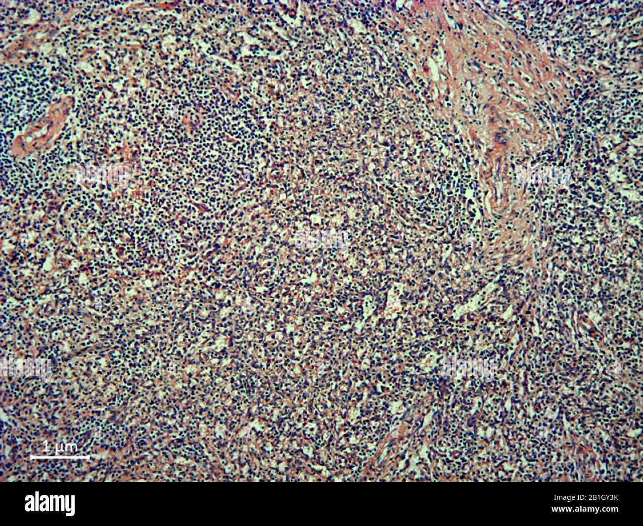 histological cut of tissue of spleen, chronic myeloic leuceamia  blood smear, 500x Stock Photo