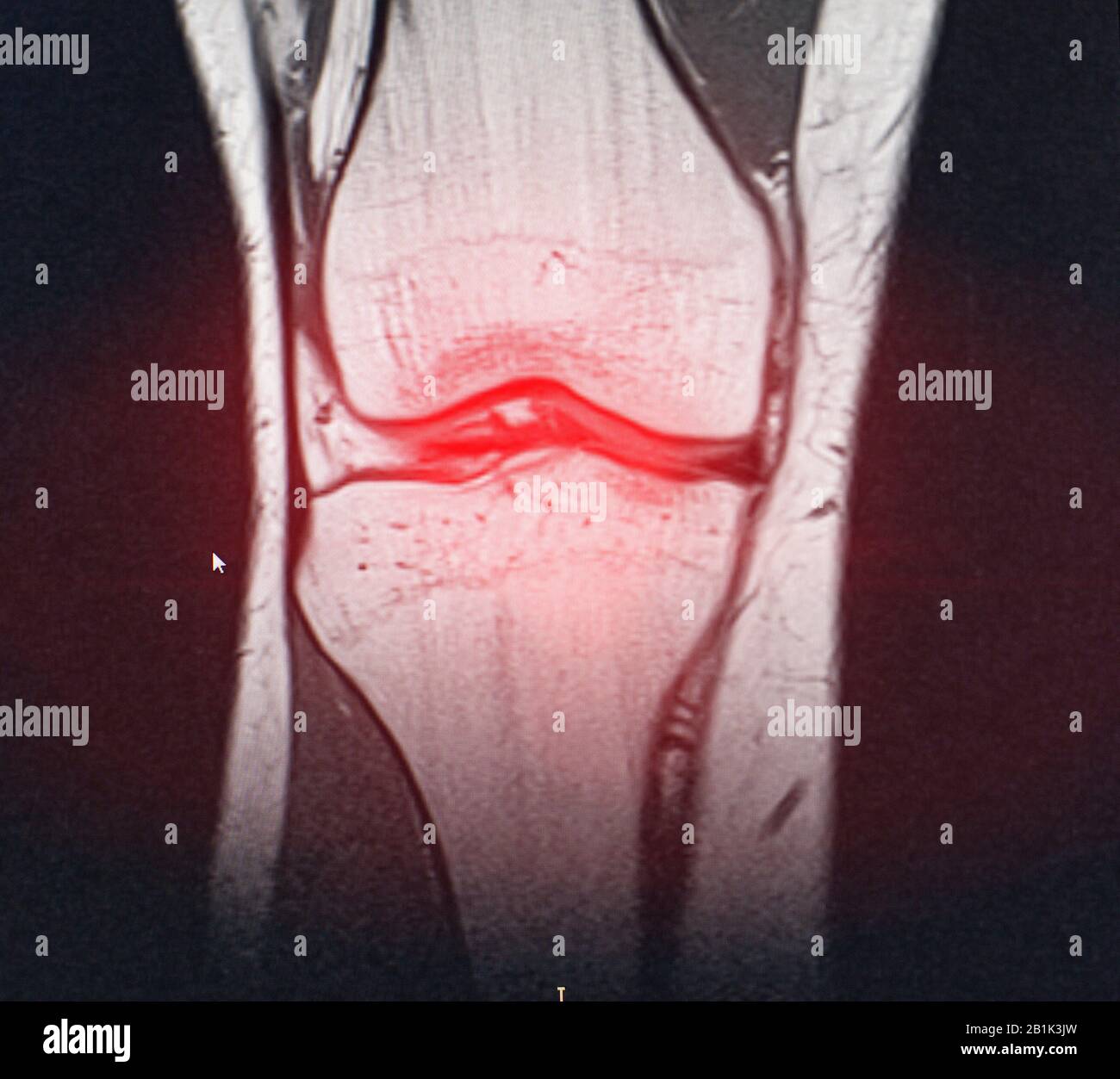 A snapshot of the diagnosis of an MRI of the knee in which arthrosis and arthritis. The concept of joint diagnosis using x-rays, treatment of diseases Stock Photo