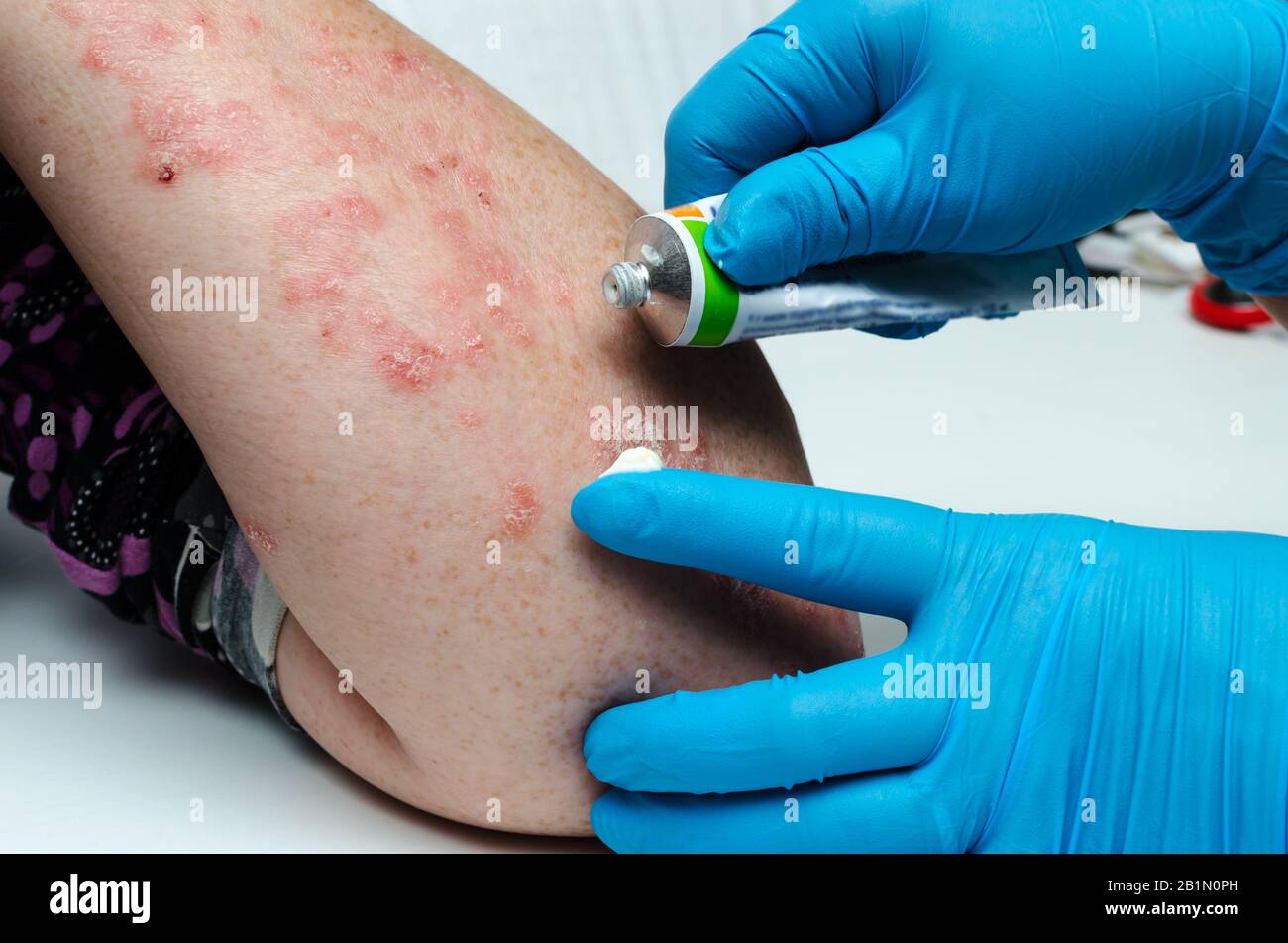 A dermatologist in gloves applies a therapeutic ointment to the