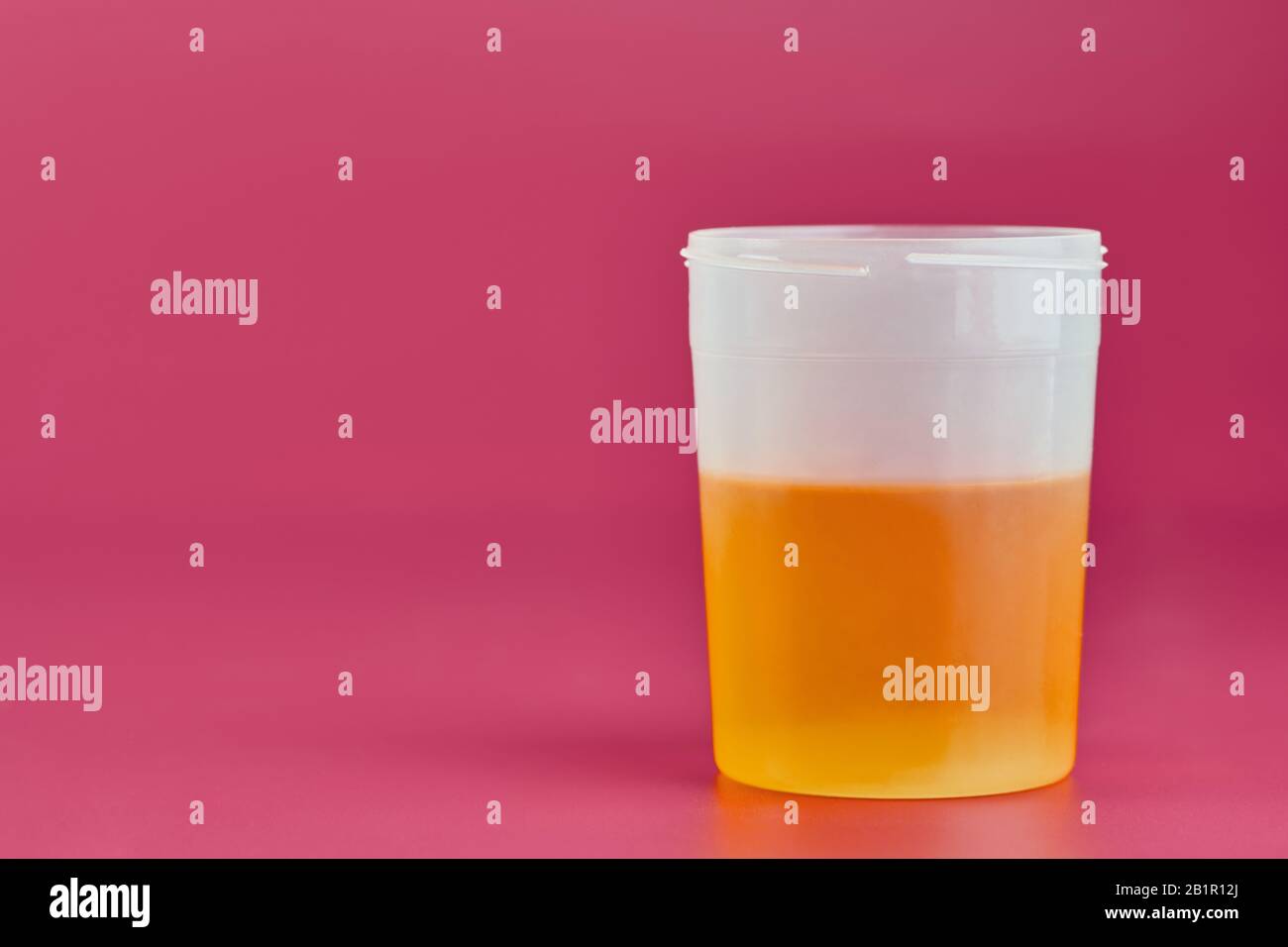Urinalysis for urolithiasis in container. Urine samples for analysis in