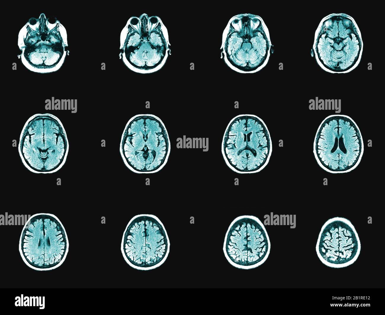 Human head and brain computer tomography image set. Horizontal partition of medical examining or anatomy study Stock Photo