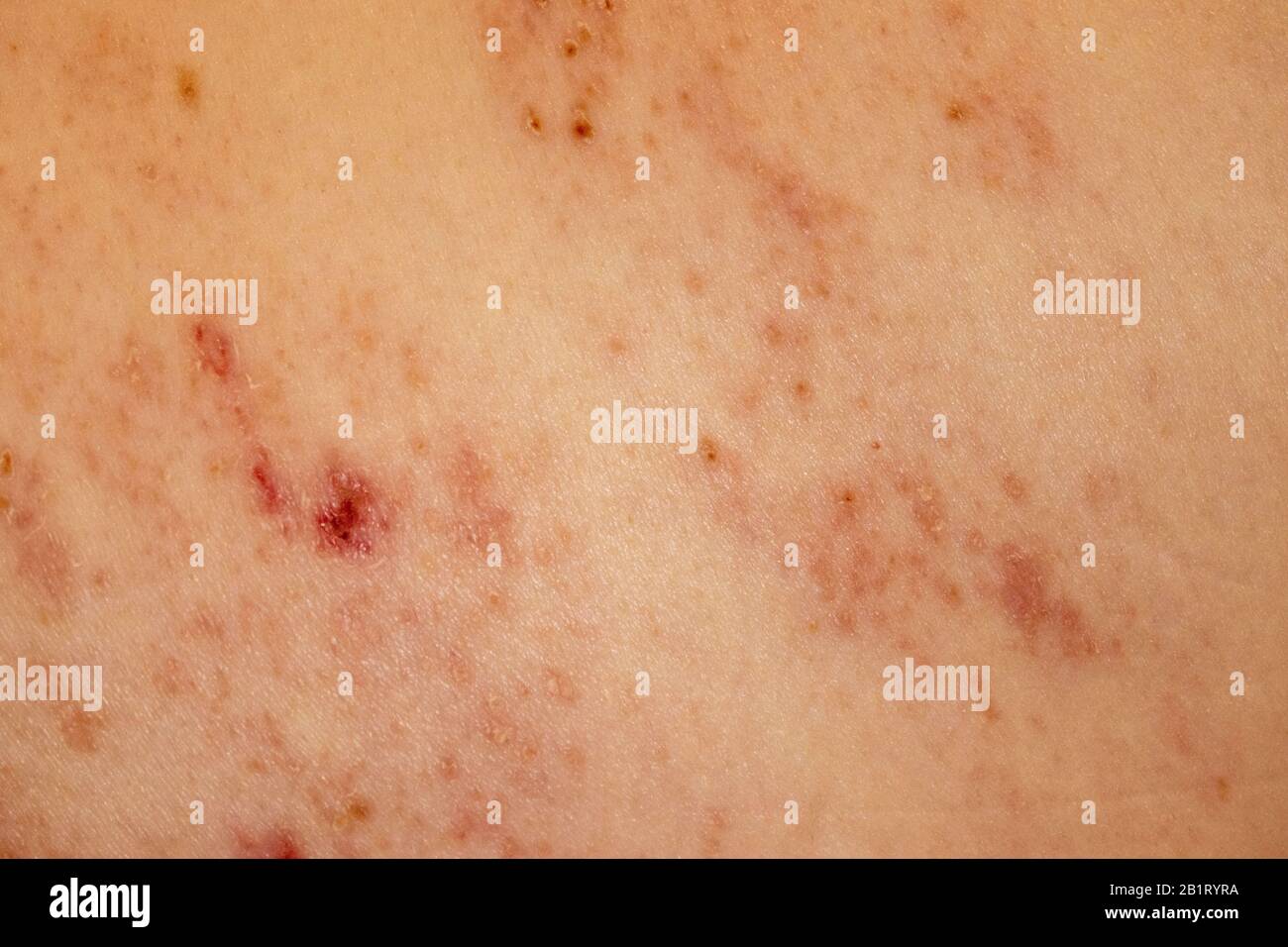 Shingles Herpes Zoster infection Rash Caucasion Male 59 years old Stock Photo