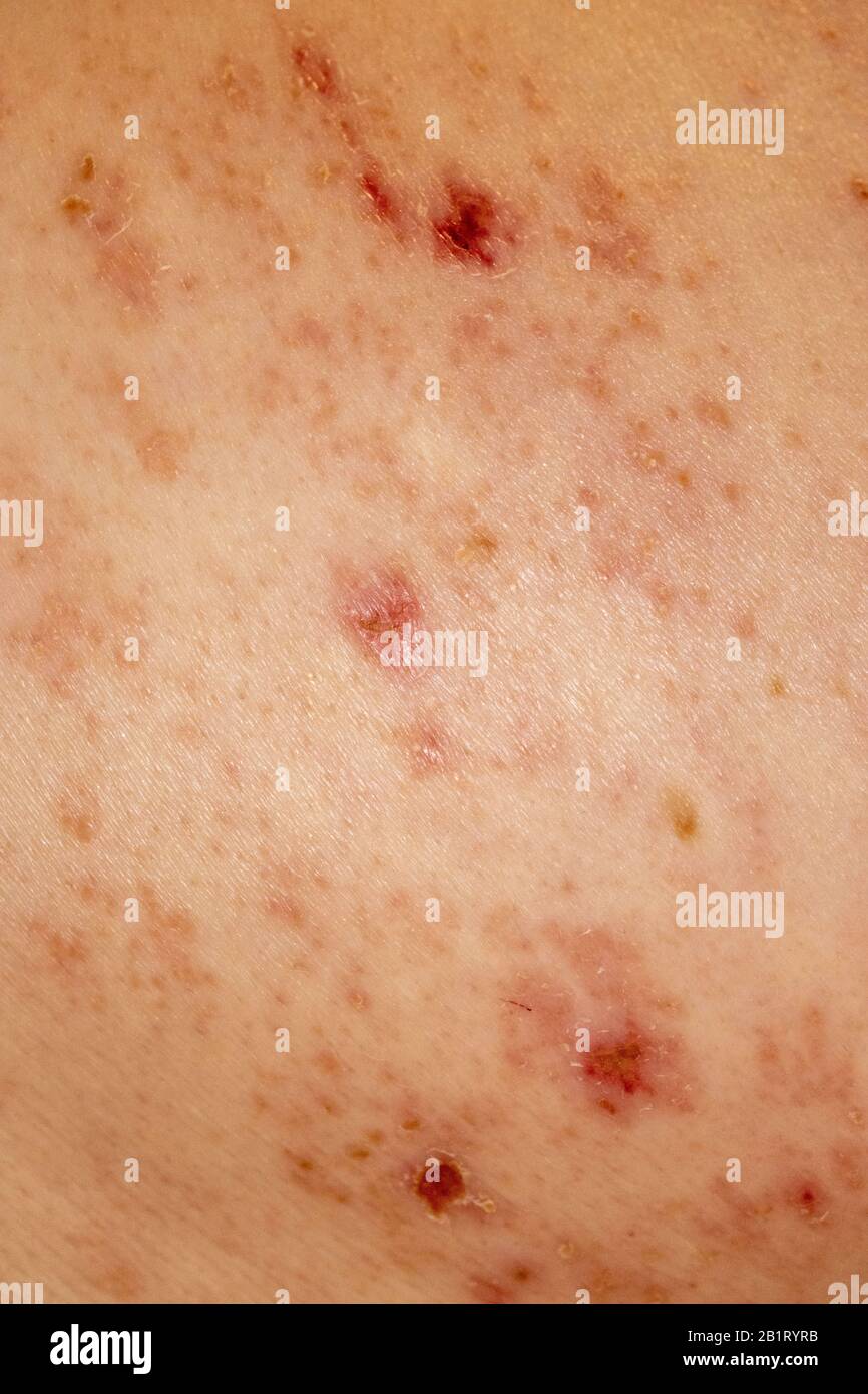 Shingles Herpes Zoster infection Rash Caucasion Male 59 years old Stock Photo