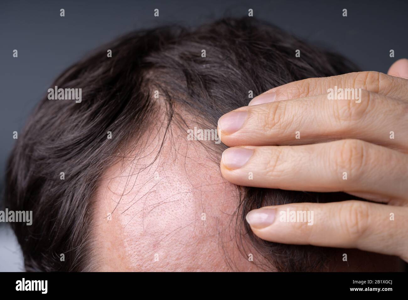 Close-up Of Young Man Checking Hairline At Home Stock Photo