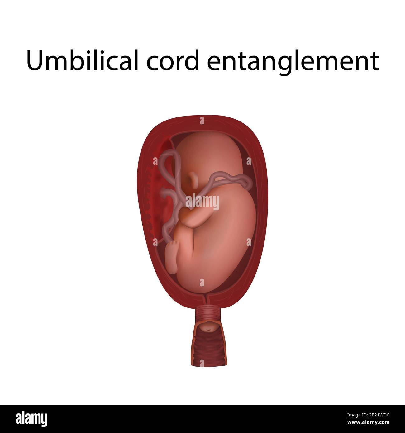 Umbilical cord entanglement, illustration Stock Photo Alamy