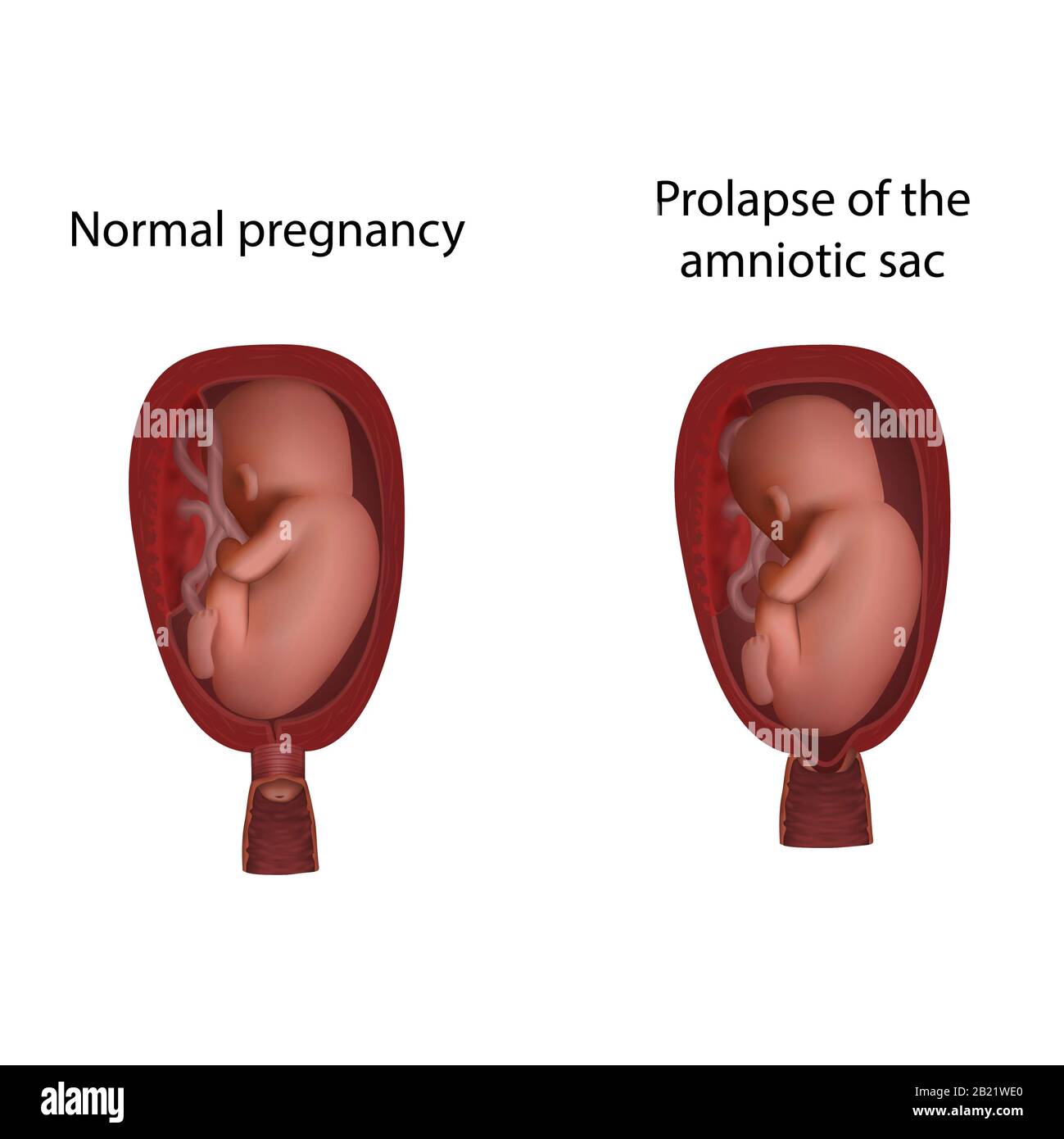 Amniotic sac prolapse and normal pregnancy, illustration Stock Photo - Alamy