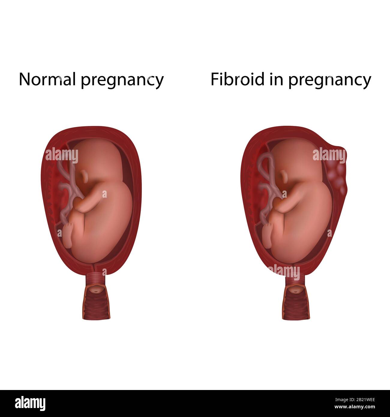 Fibroid in pregnancy and normal pregnancy, illustration Stock Photo