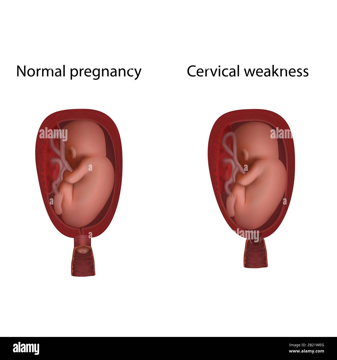 Cervical weakness and normal pregnancy, illustration Stock Photo - Alamy