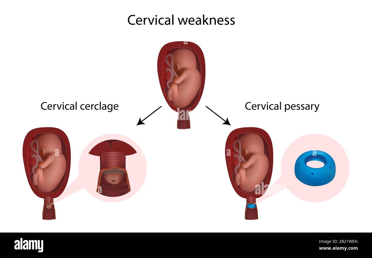 Cervical weakness, cerclage and pessary, illustration Stock Photo