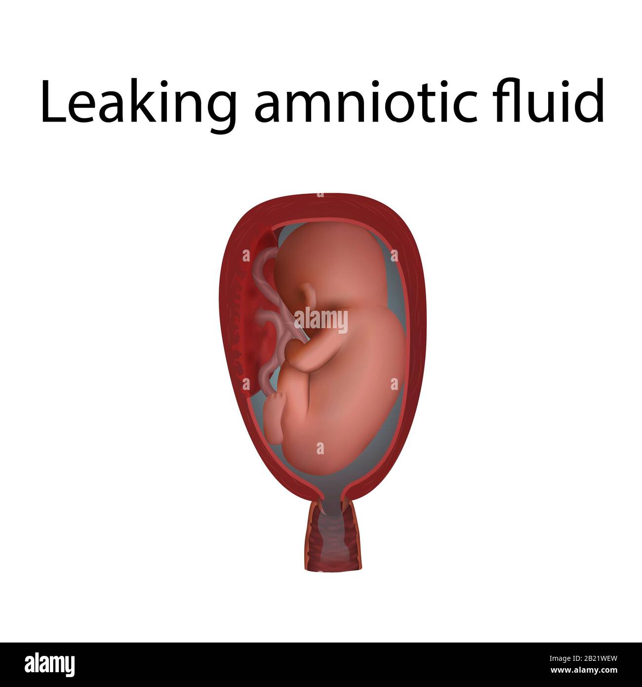 Leaking Amniotic Fluid: Signs in 1st to 3rd Trimester