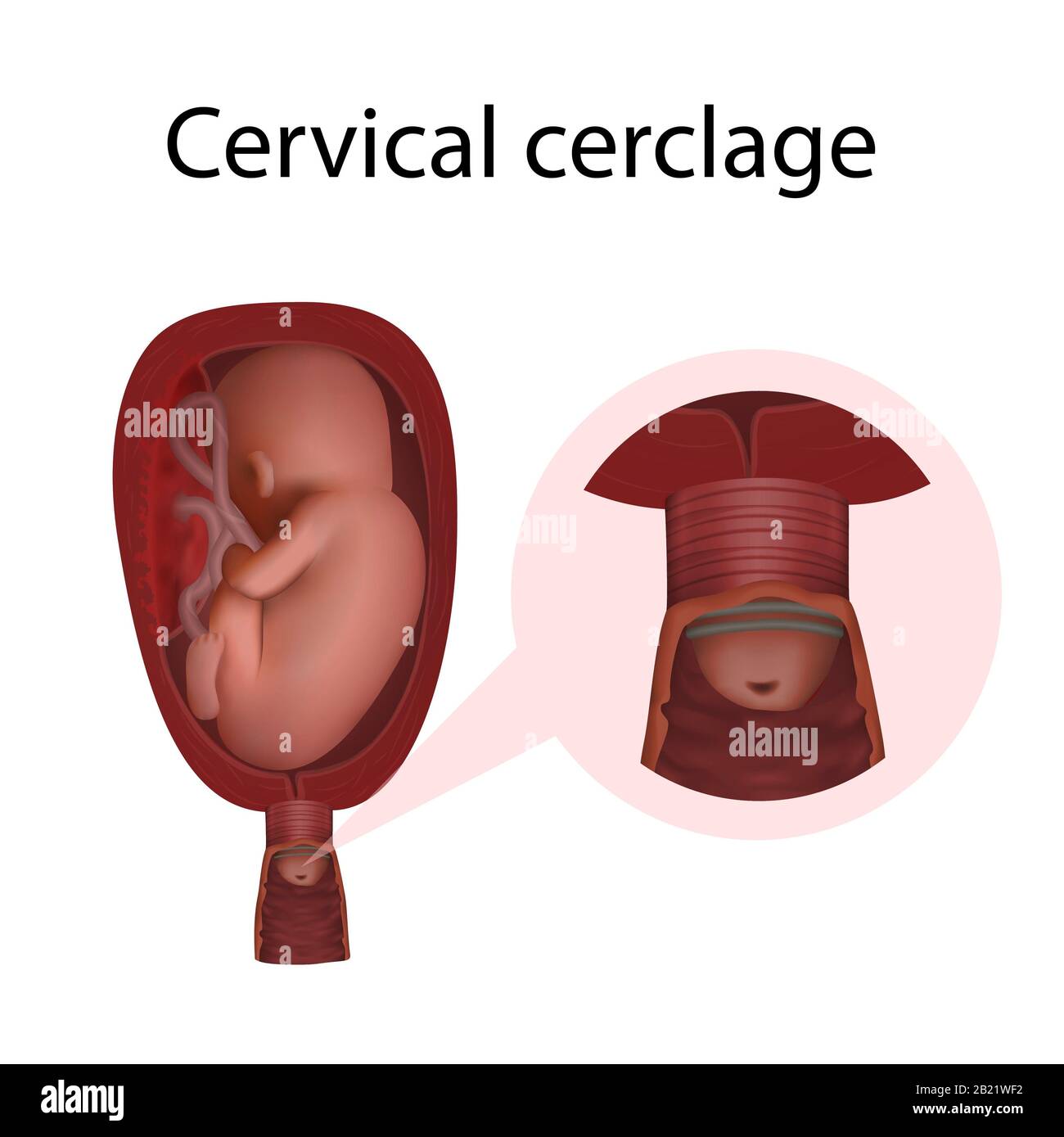 Cervical cerclage, illustration Stock Photo - Alamy